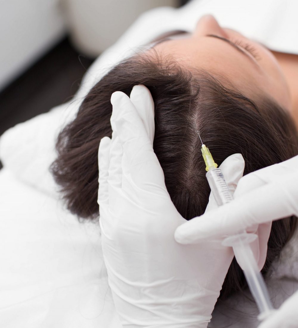 treatment of hair loss, injection for hair growth. Injected in woman's head, hair mesotherapy