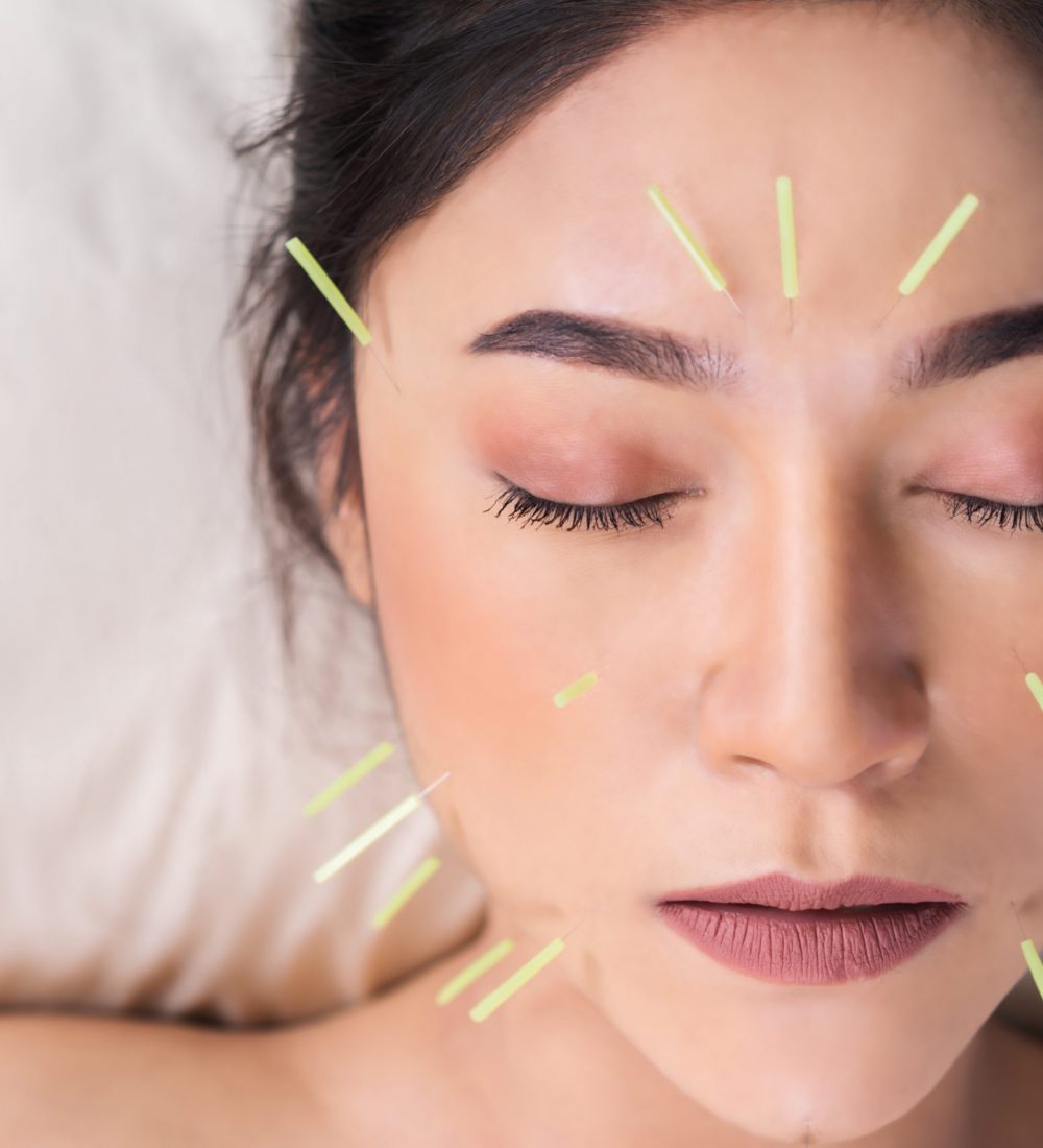 young woman undergoing acupuncture treatment on face