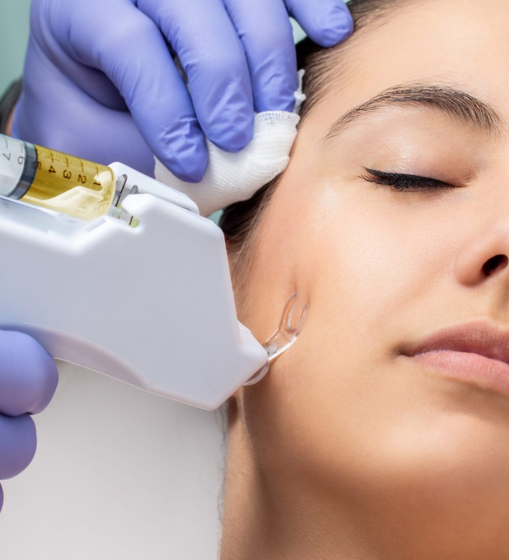 Therapist removing scar with micro needling technology. Non surgical treatment applied on female cheek.
